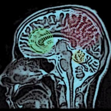 Voir la vidéo de Palpations de cerveau