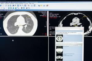 Contre la détresse respiratoire, vers une lecture automatique des scanners ?