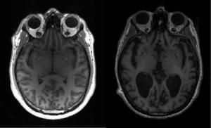 La cause de la progression de la maladie d’Alzheimer dans le cerveau découverte 