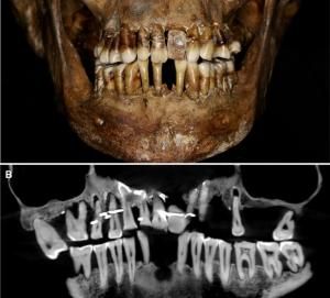 Une aristocrate du 17e siècle racontée par sa dentition