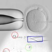 Voir la vidéo de Infertilité, la science progresse